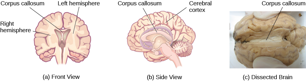 <p><span>a thick band of neural fibers that allows the two hemispheres to communicate with each other and allows for information being processed on one side of the brain to be shared with the other side</span></p>