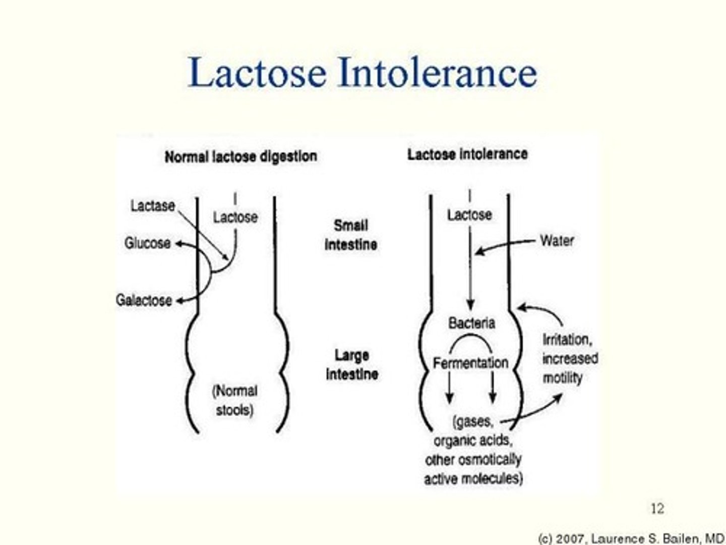 <p>Lactose fermented by bacteria in the colon produces gases such as CO2, methane, hydrogen, and osmotically attracts fluid into the bowel lumen, causing diarrhea.</p>