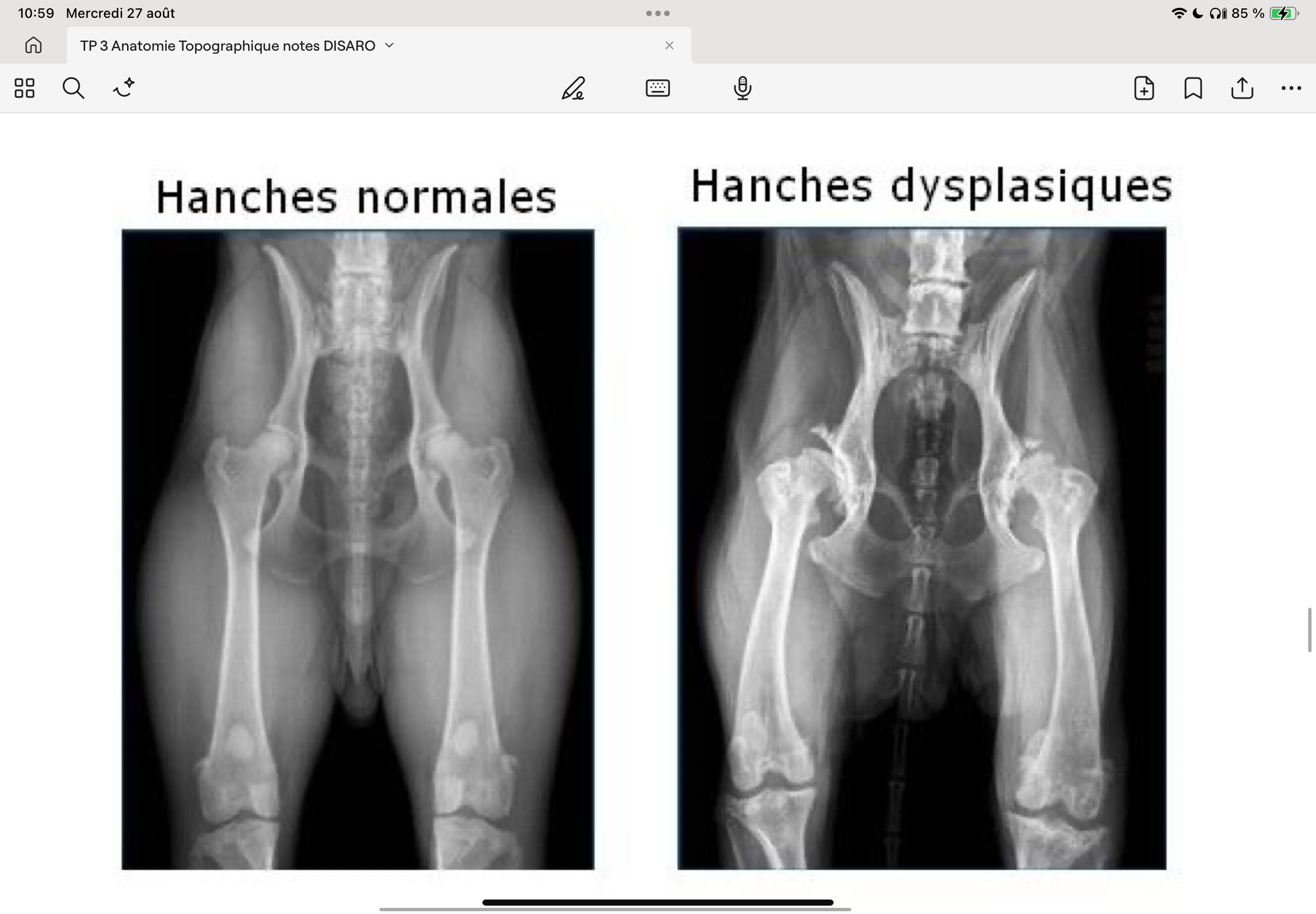 <p>Dysplasie de hanche : combinaison de plusieurs lésions au niveau de la tête fémorale et de la cavité acétabulaire ce qui donne lieu à une mal articulation et des douleurs importantes.</p><p>On décrit plusieurs grades de la maladie, voir cours de radio (calcul de l’angle de Norberg, qui calcule la couverture de la tête fémorale par l’acétabulum) et de chirurgie.</p><p>Diagnostique: Avec une radio ventro-dorsale (chien couché sur le dos, bien positionné, pas tordu !), bonne relaxation musculaire, donc anesthésie générale.</p>