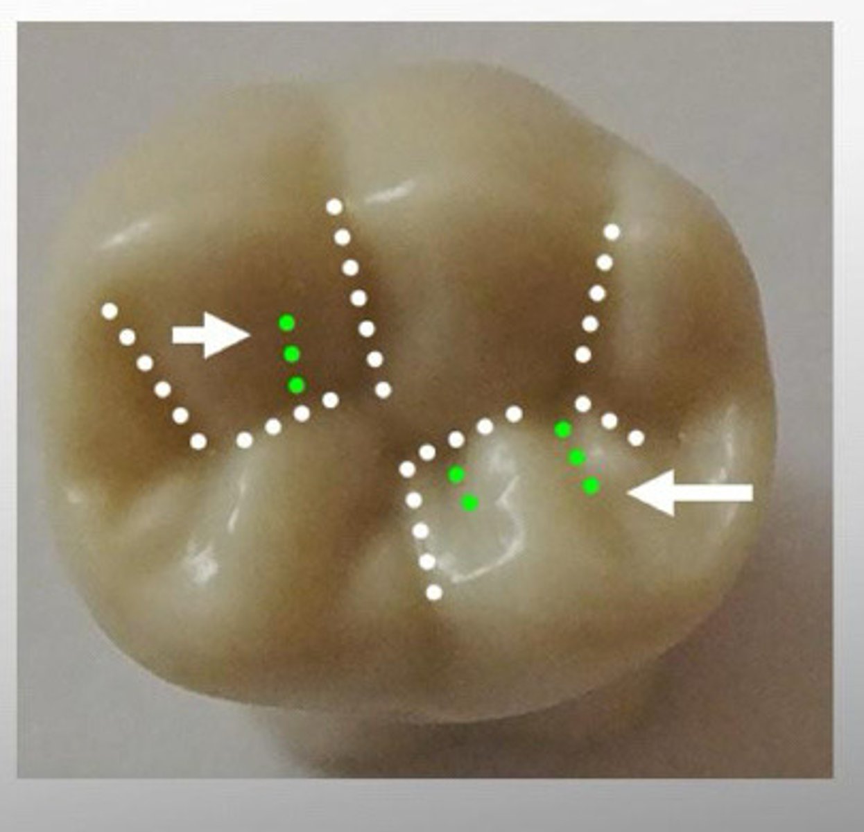 <p>Small Irregularly placed grooves not at the junction of lobes or major portions of the teeth</p>