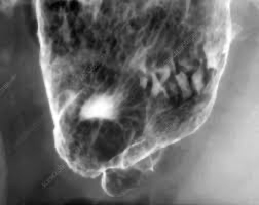 <p>Stomach and duodenum</p><p>Usually seen on lesser curvature<br>Caused by acid and pepsin</p><p>Complications- bleeding</p>