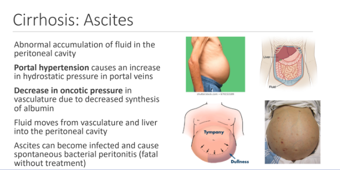 <p> vasculature; peritoneal cavity; spontaneous bacterial peritonitis</p>