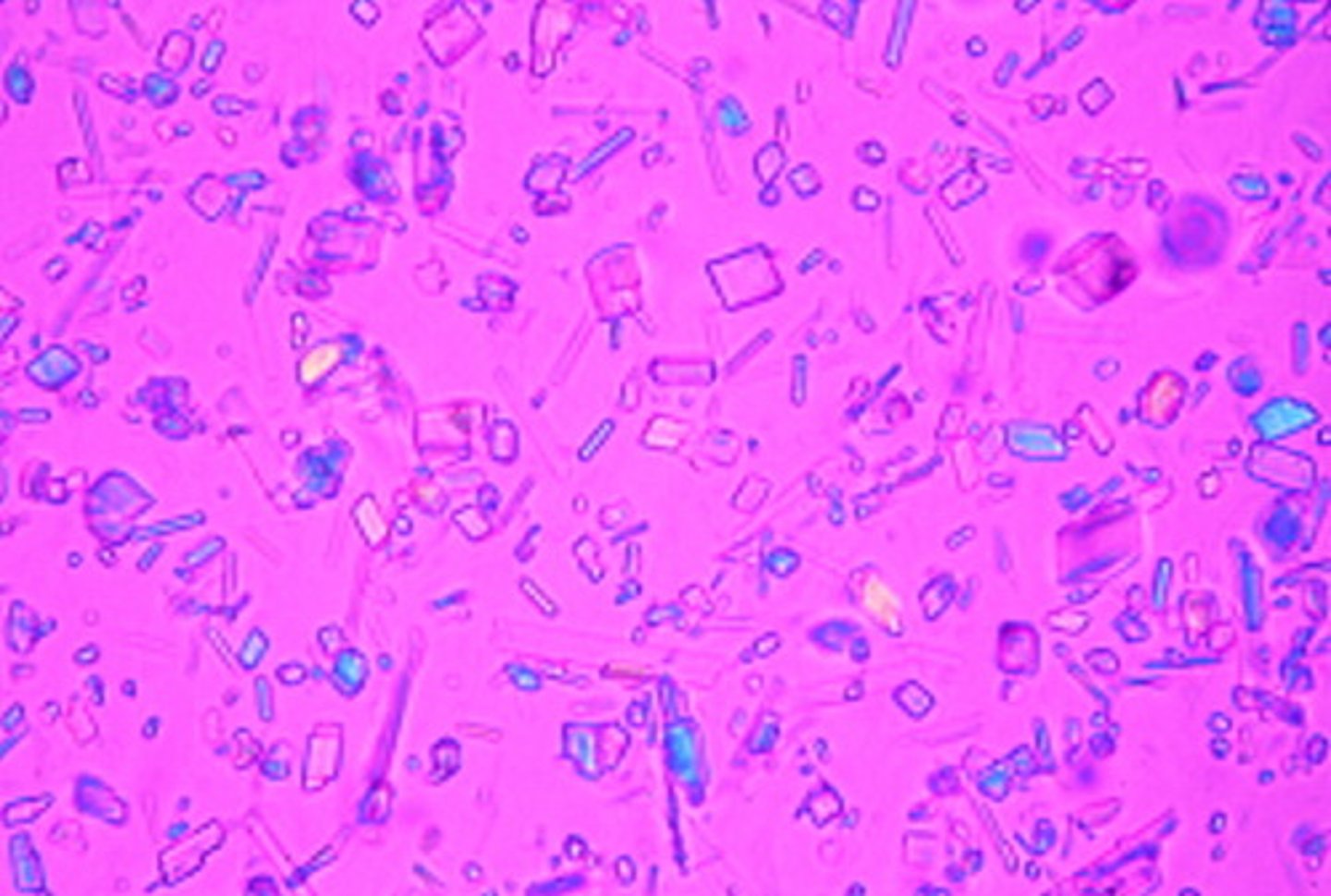 <p>= calcium pyrophosphate rod-like or rhombic crystals</p>