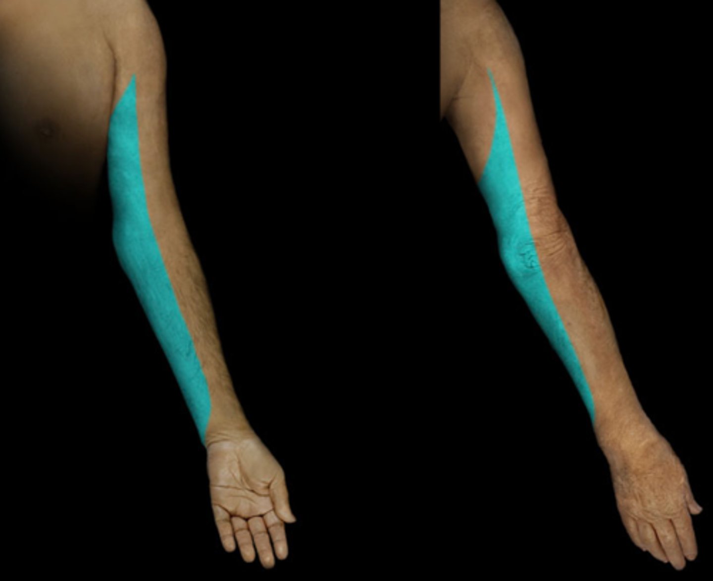 <p>Dermatome: Medial side of forearm to base of little finger</p><p>Muscles innervated: Finger abductors</p><p>Reflexes (if any): None</p><p>Paresthesias: None</p>