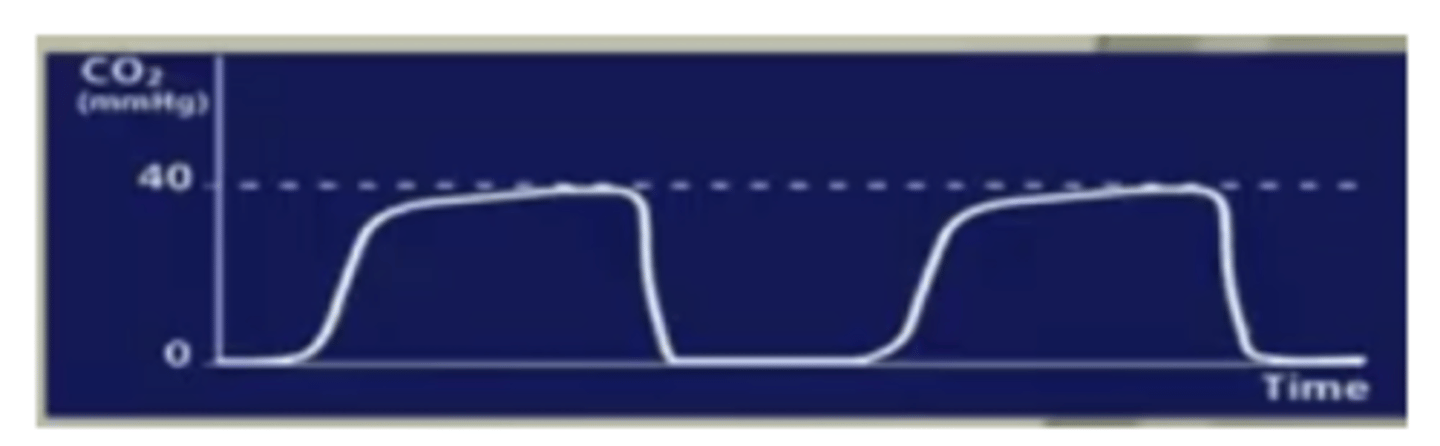 <p>¿este paciente está bien intubado?</p>