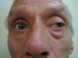 <p>Oculomotor (III) Palsy</p>