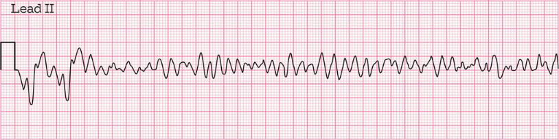 <p>Ventricular Fibrillation - cardiac arrest with irregular uncoordinated rippling contractions of ventricles with no effective cardiac output</p>