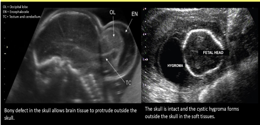<p>an encephalocele can be easily be mistaken for </p><p>a) gastroschisis</p><p>b) porencephaly</p><p>c) epignathus</p><p>d) cystic hygroma</p>
