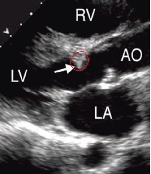 <p><strong>fixed stenosis</strong> and considered <strong>NON VALVULAR</strong> (valve could be completely normal) </p>