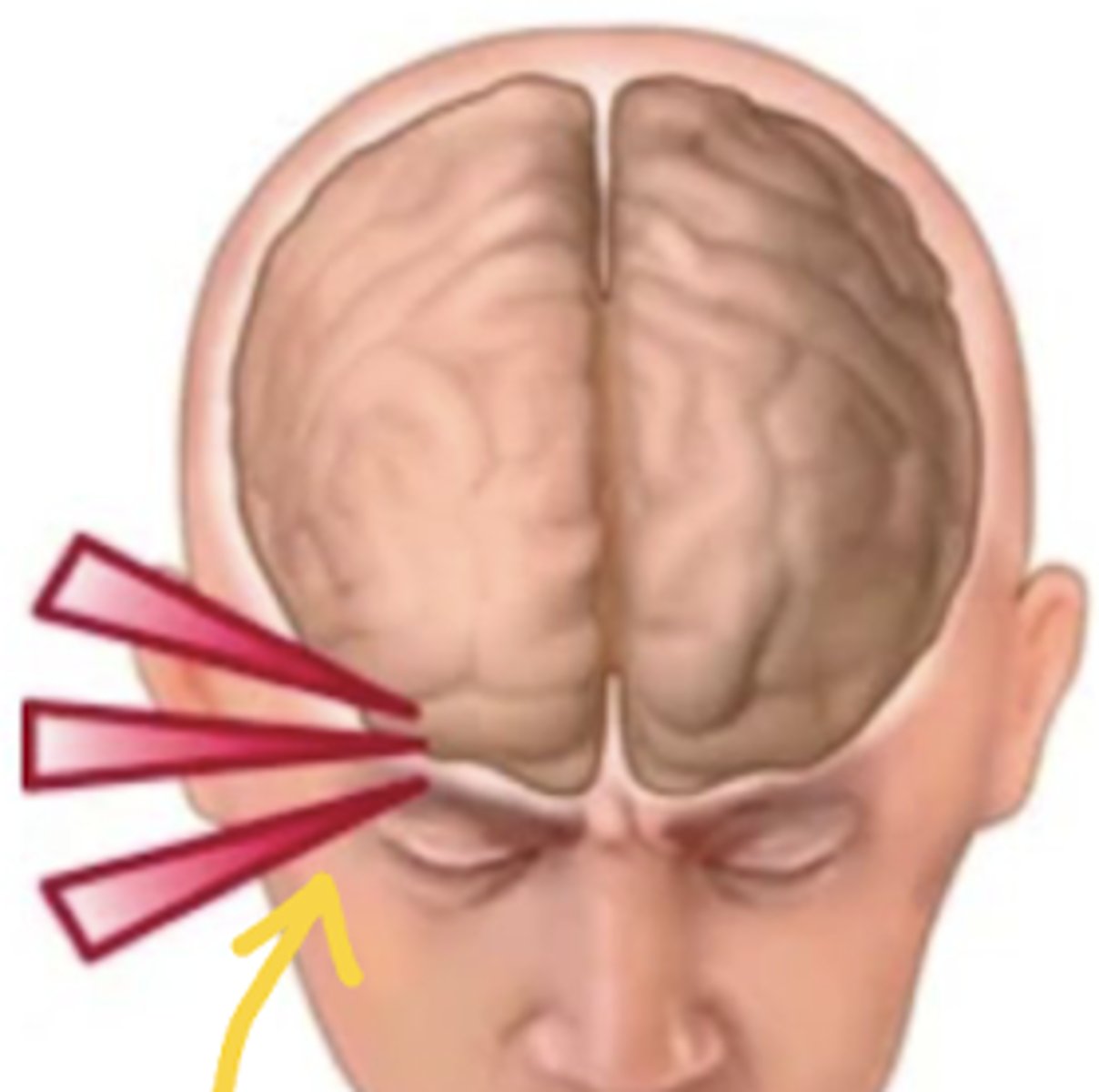<p>- One spot, in "clusters."</p><p>- Abrupt onset, peaks in minutes.</p><p>- Can occur multiple times a day, and can last weeks.</p><p>- Cause: alcohol, nitroglycerine, histamine, organic compounds (paint, perfume, gas?).</p><p>- Pain: continuous, sharp, burning, piercing, and excruciating.</p><p>- Tx: preventative meds</p>