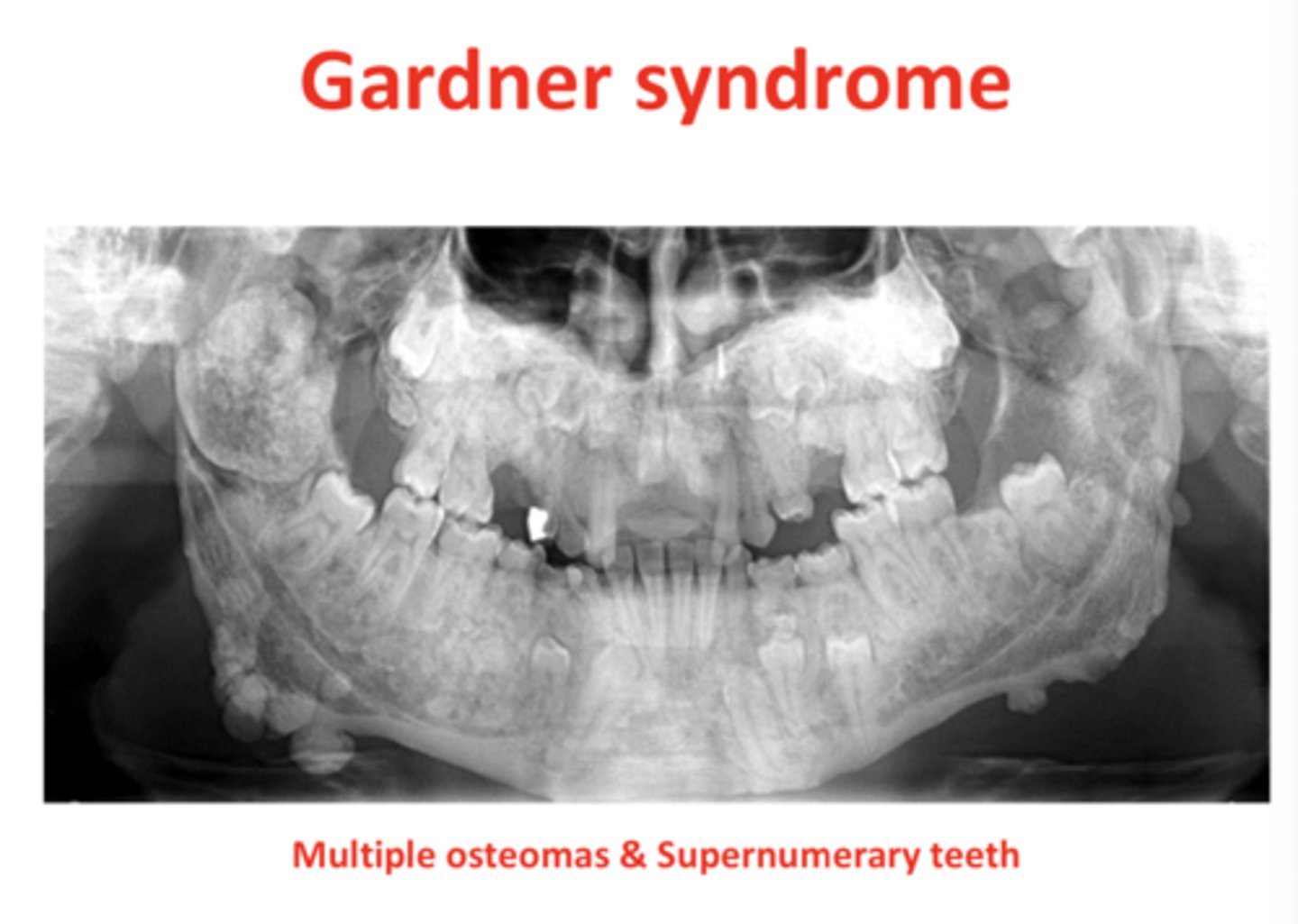 <p>Supernumerary teeth, osteomas, polyps</p>