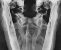 <p><span><span>Rostral caudal open mouth - usually easy to see b/c gas filled structures prevent superimposition</span></span></p>