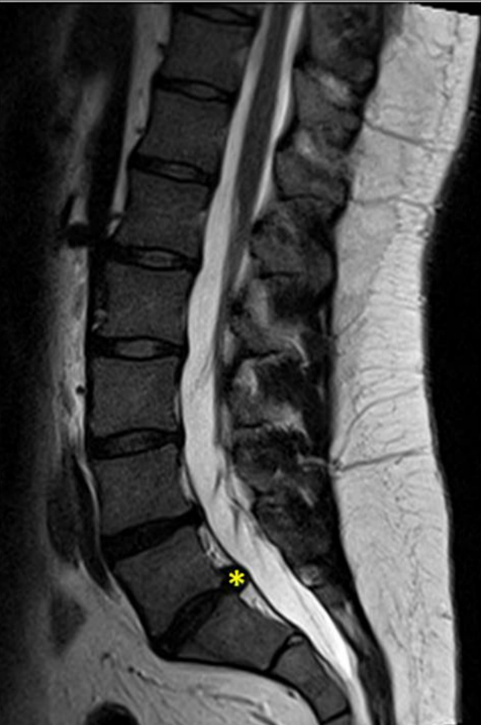 <p>Imaging from a 44-year-old male with low back pain over the past 3 months reveals the results shown in the accompanying image. A postero-lateral disc herniation is indicated by the yellow asterisk. Which of the following most correctly indicates the level of the herniation and a sign/symptom that would be consistent with this injury?</p><p>A.      L3/4; fasciculations in gracilis</p><p>B.       L3/4; sensory loss over lateral malleolus</p><p>C.       L4/5; patellar reflex of 3/4</p><p>D.      L4/5; sensory loss over medial malleolus</p><p>E.       L5/S1; calcaneal reflex of 1/4</p><p>F.       L5/S1; fasciculations in vastus medialis</p><p>G.      S1/2; Trendelburg sign</p><p>H.      S1/2; urinary incontinence</p>