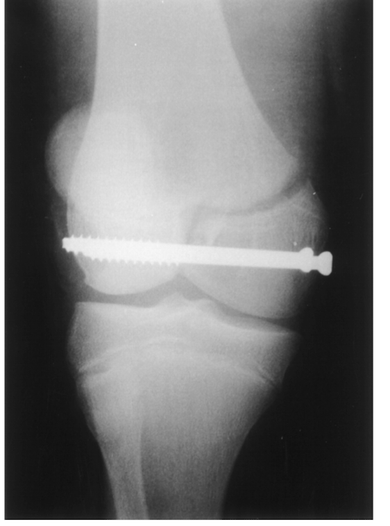 <p>Knee: Salter Harris Fx</p><ul><li><p>What type of fx is this?</p></li><li><p>This type of fx is unique to what population?</p></li><li><p>Where can this fx occur? </p></li></ul><p></p>