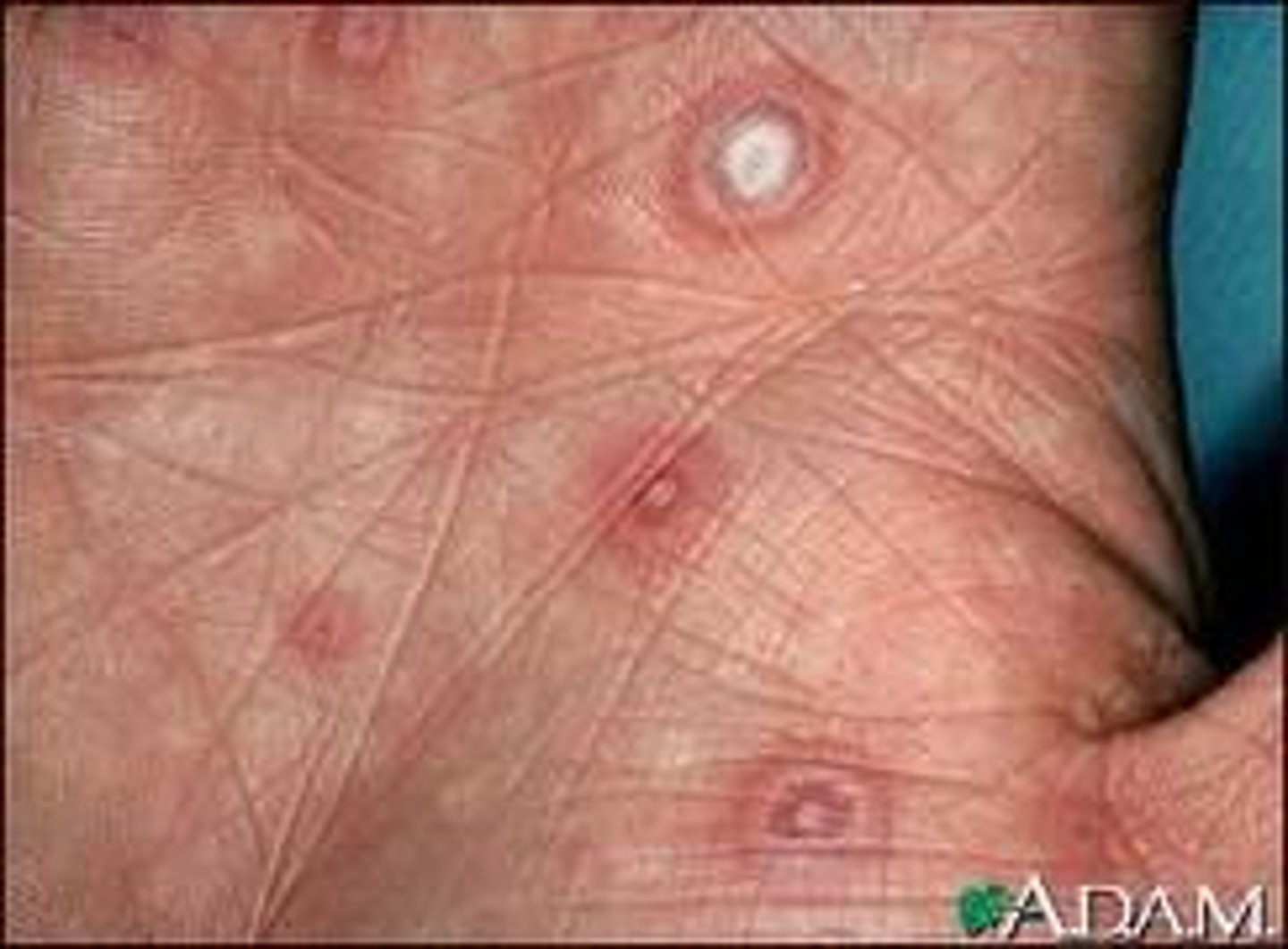 <p>Erythema multiforme</p>