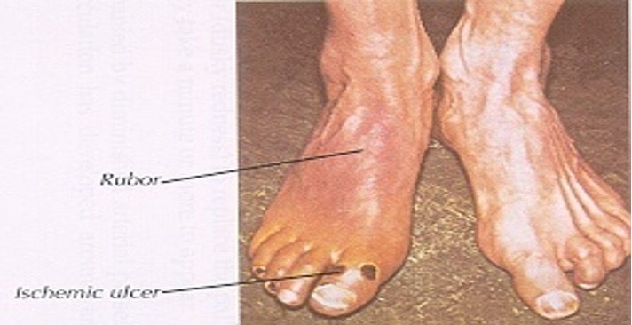 <ul><li><p>pallor of foot when raised to 60 degrees for 1 min</p></li><li><p>pain when walking; usually assoc w/ intermittent claudication</p></li><li><p>pale or dusky red color (rubor)</p></li><li><p>cool temp</p></li><li><p>no edema</p></li><li><p>thin/shiny skin</p></li><li><p>loss of hair</p></li><li><p>painful ulcerations (trauma)</p></li><li><p>dry gangrene</p></li><li><p>dec pulses</p></li></ul><p></p>