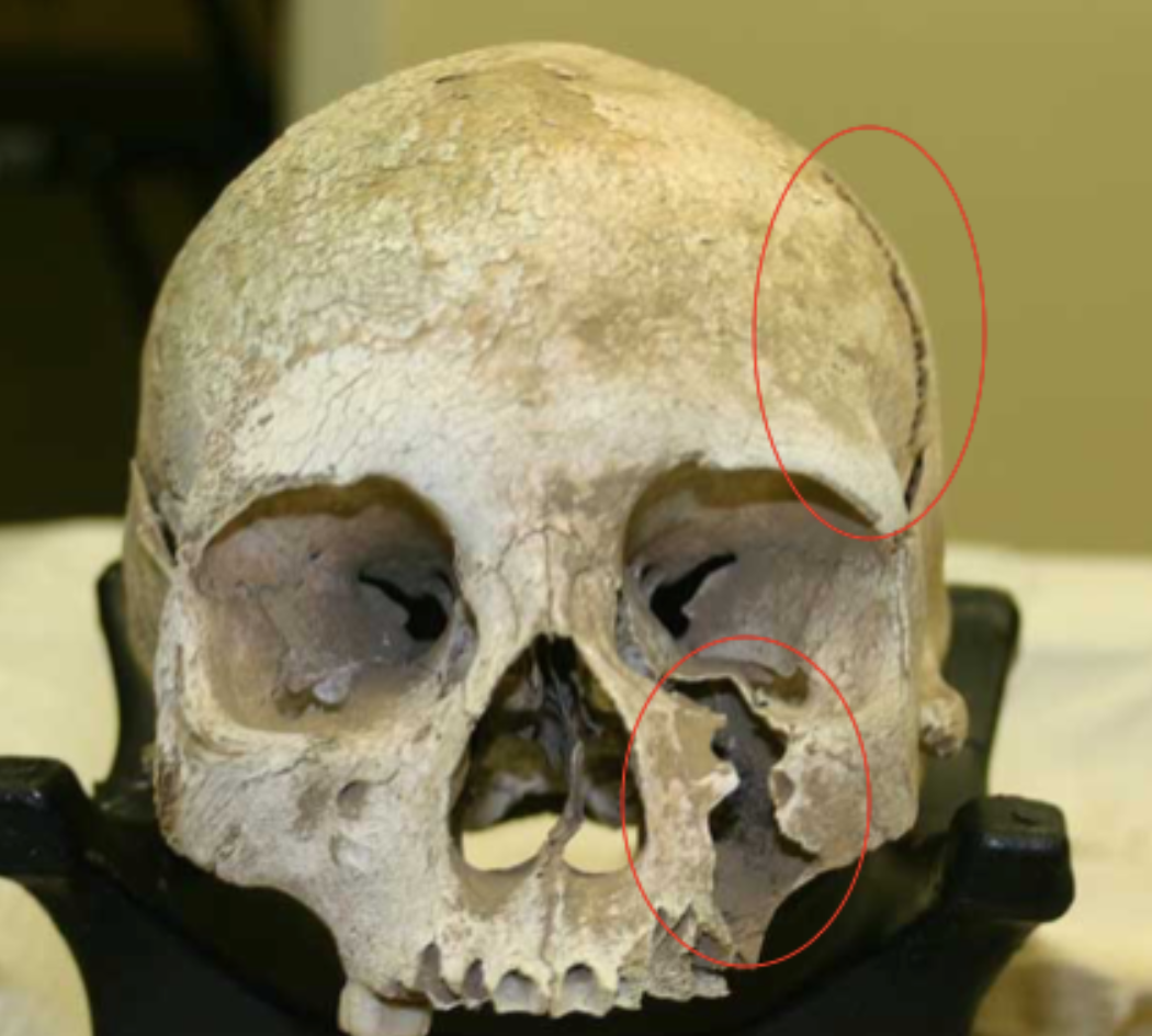 <p><span>Are these injuries antemortem, perimortem, or postmortem?</span></p>