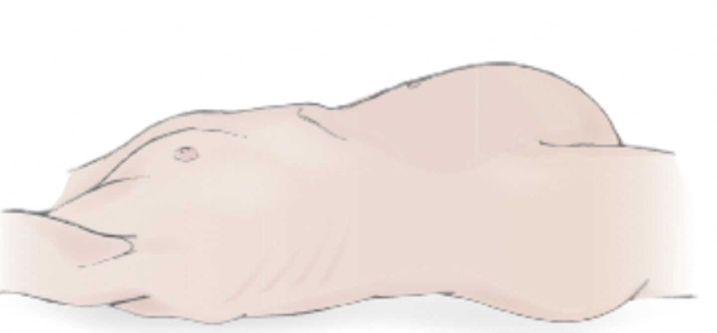 <p>bloating; can be present in one or more quadrants; indictive of chromes disease or celiac's disease</p>