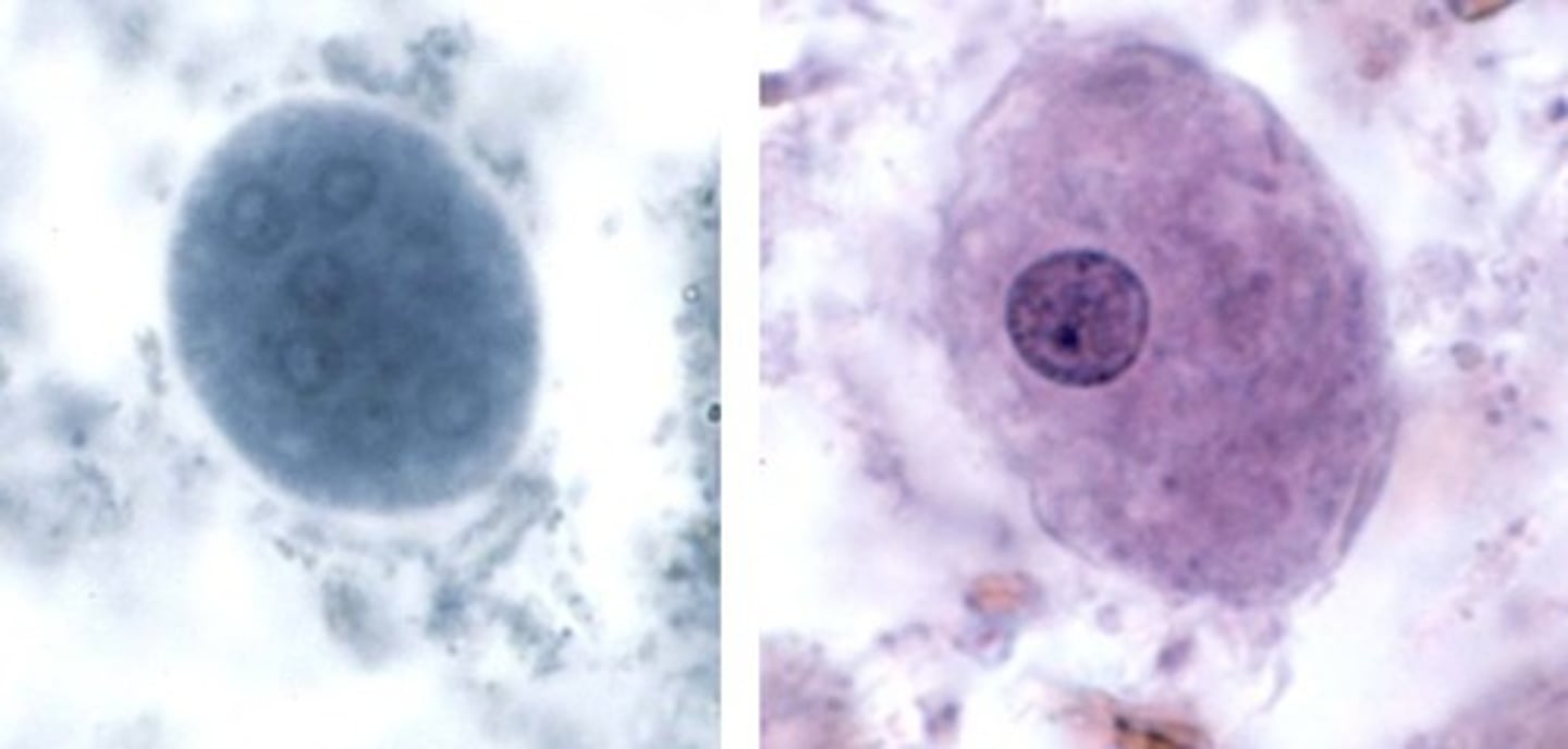 <p>• Cyst (left)</p><p>o Up to 8 nuclei</p><p>• Trophozoite (right)</p><p>o 20-25 microns</p><p>o Eccentric karyosome</p><p>o Clumpy peripheral</p><p>chromatin</p>