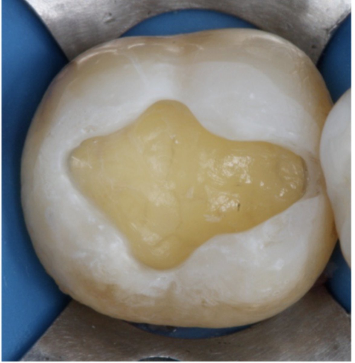 <p>Properly etched enamel will appear frosty or chalky white when air-dried</p>