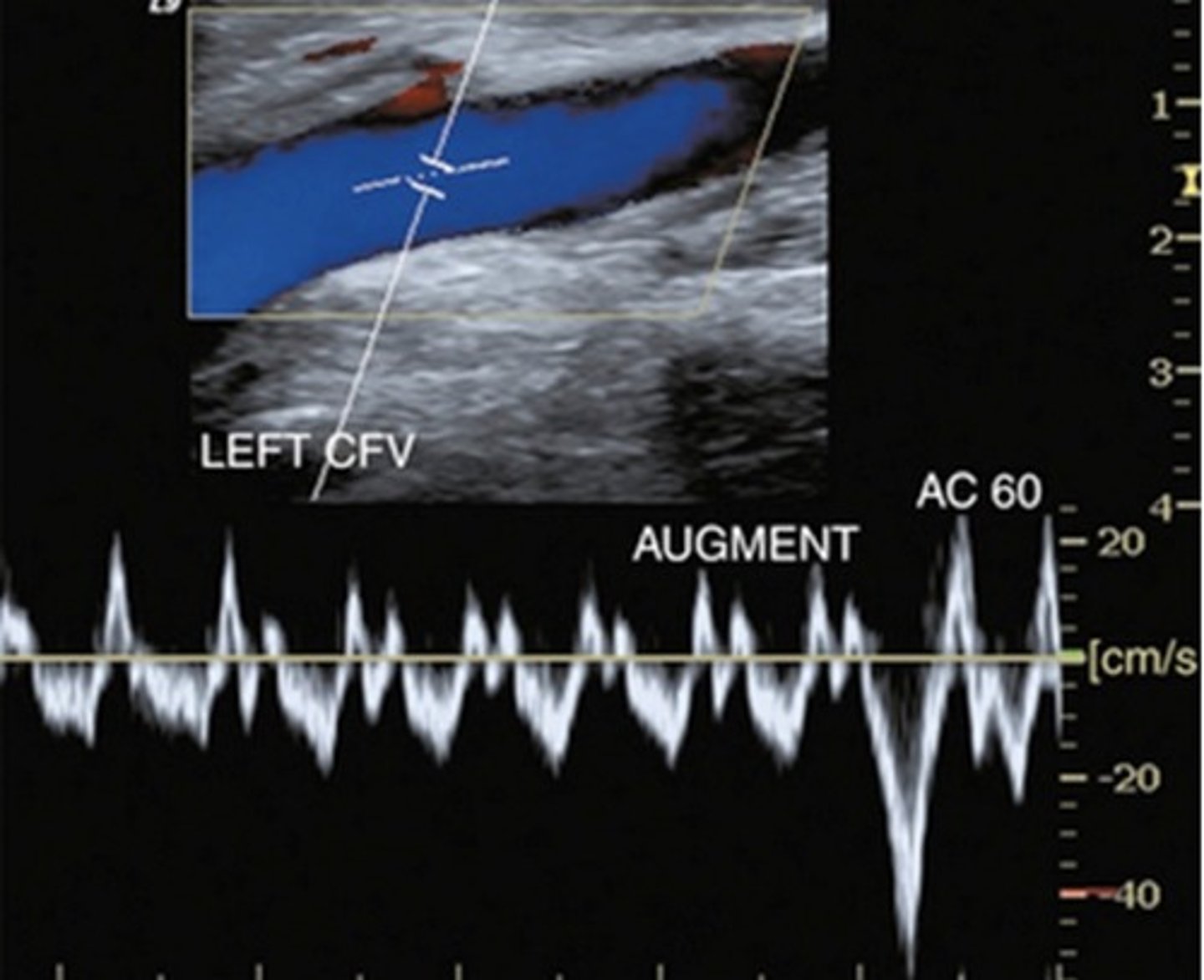 <p>Bidirectional pattern</p><p>Indicative of elevated right heart pressure</p>