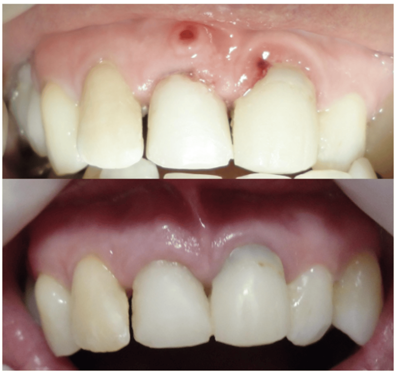 <p>What does this show on the tooth?</p>