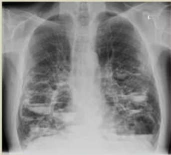 <ul><li><p><span>Dilatation caused by congenital deficiency and weakening of the muscular and elastic layers in the bronchial walls</span></p></li><li><p><span>ring shadows</span></p></li><li><p><span>increased bronchiole diameter</span></p></li></ul><p></p>