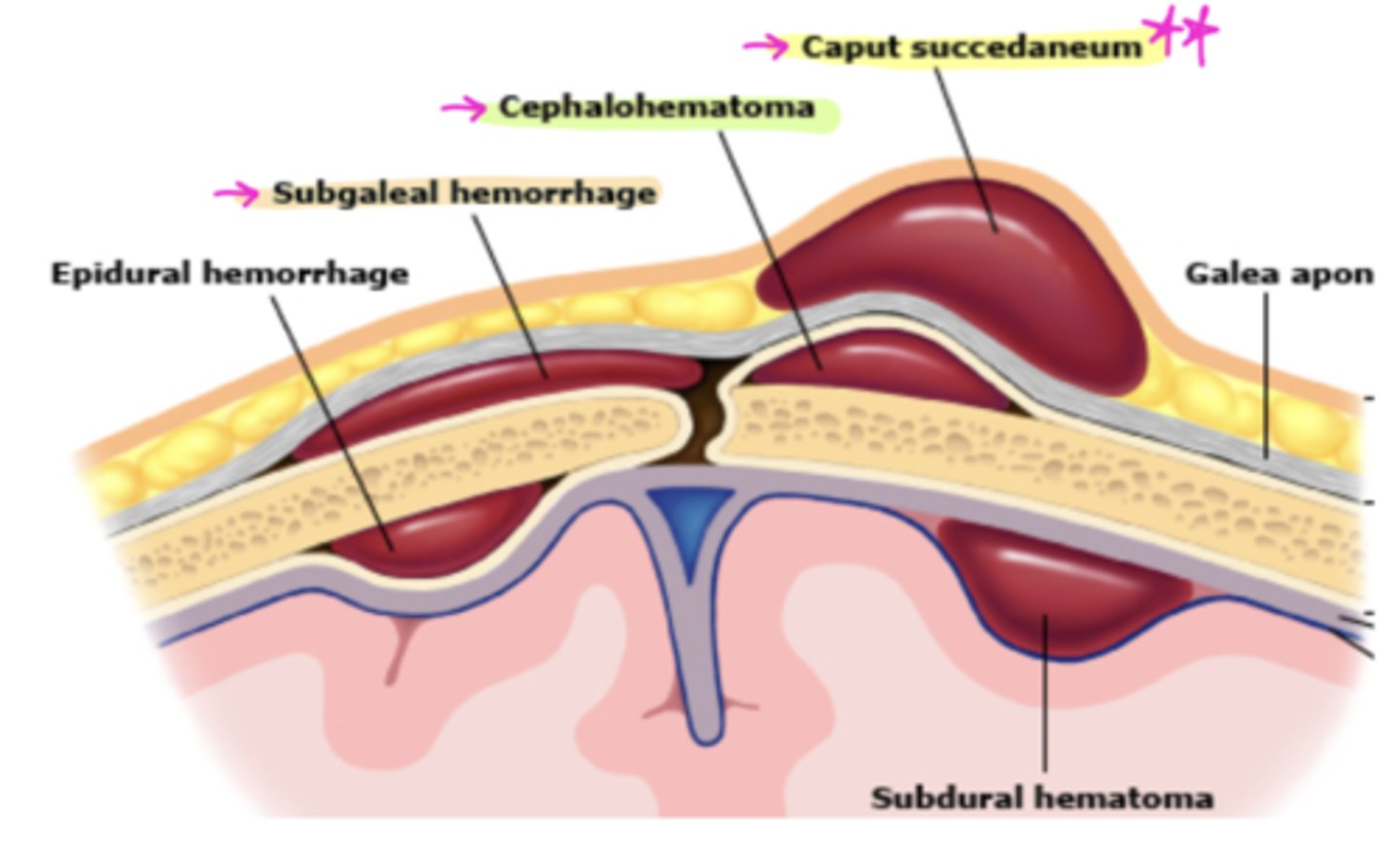 <p>Caput succedaneum 🧢</p><p>Cephalohematoma: blood collection under periosteum (does NOT cross suture line)</p><p>Subgaleal hemorrhage: btw scalp + skull→blood goes to dependent side</p>