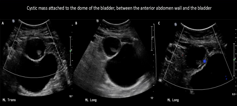 <p>incomplete resolution of which embryonic structure can cause a cystic formation between the abd wall + anterior bladder wall </p><p>a) ectoderm</p><p>b) umbilical vein</p><p>c) urachus</p><p>d) ductus venosus </p>