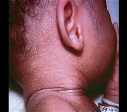 <p><strong>What are vesicles on an erythematous base to the face and trunk caused by sweat gland duct obstruction?</strong></p>