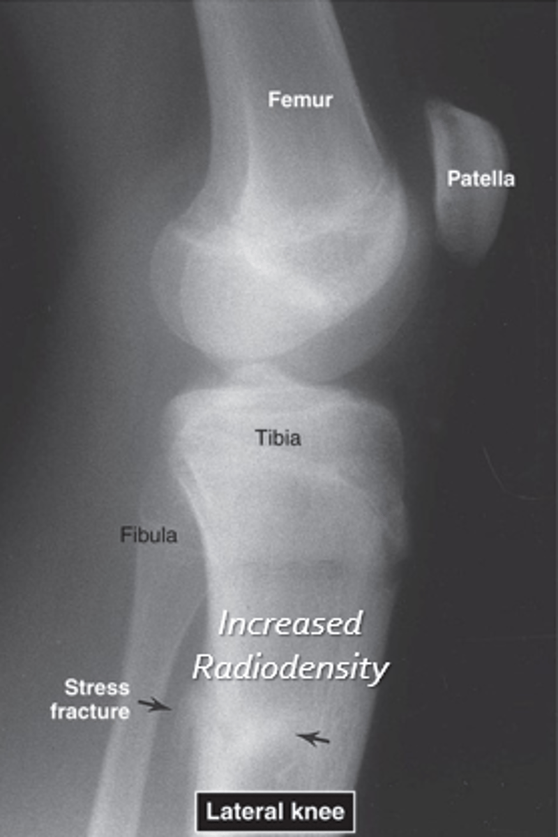<p>- Microfractures, fatigue fractures, insufficiency fractures</p><p>- Chronic high-frequency, low load</p><p>- Normal loading on abnormal bone</p>