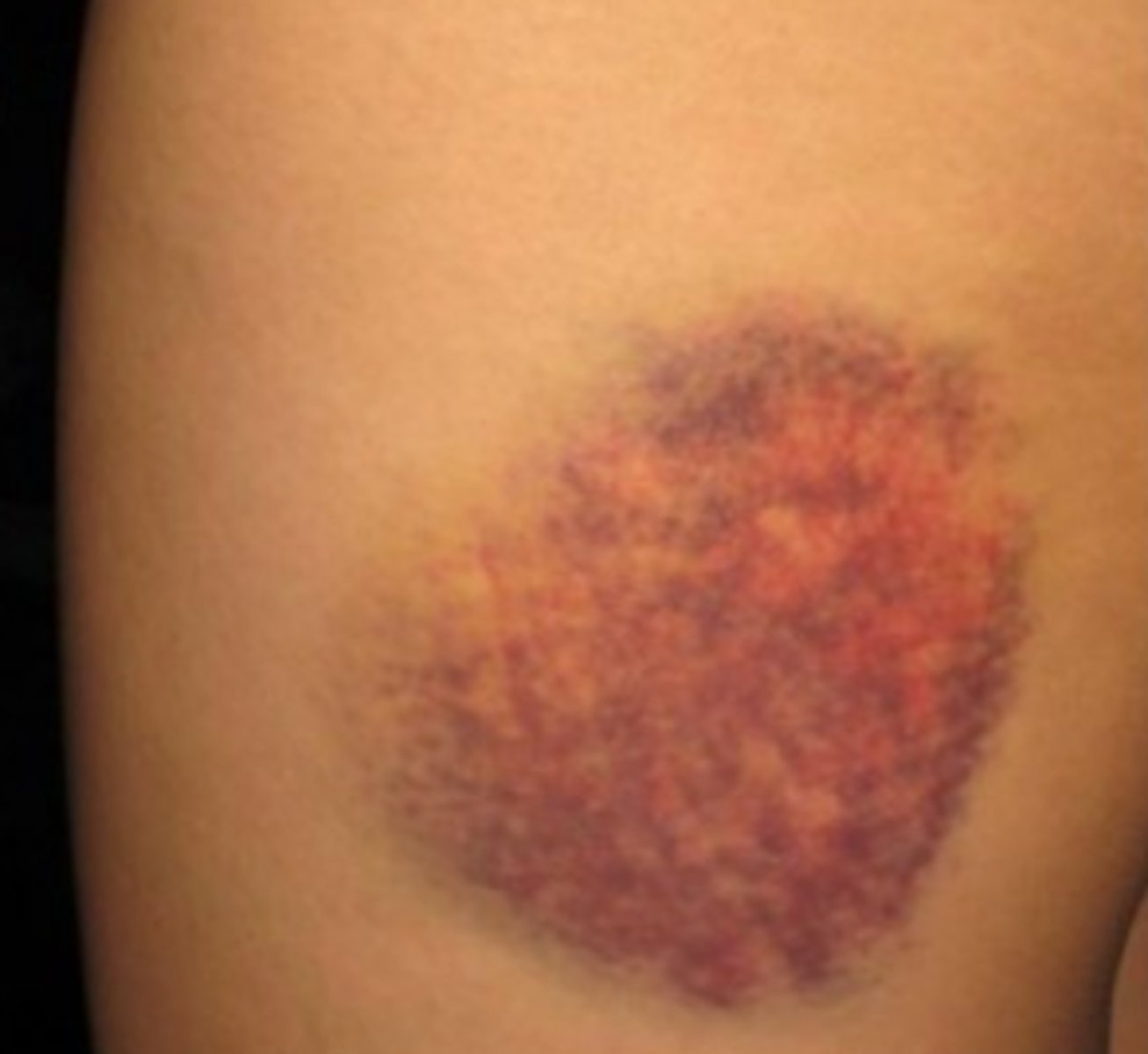 <p>bruise</p>