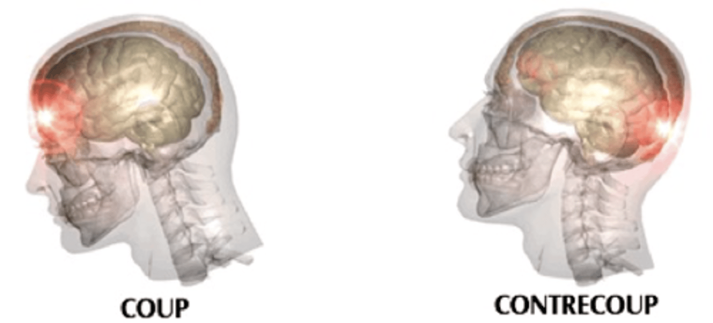 <p>Complex pathophysiologic process affecting the brain<br><br>-induced by traumatic biomechanical forces secondary to direct or indirect forces to the head</p>