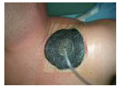 <p>Negative pressure develops to help pull exudate out of the wound</p>