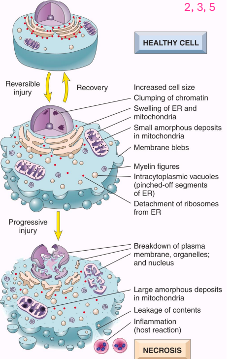 <p>- accidental cell death</p><p>- cell membranes fall apart, cell enzymes leak and digest cell</p><p>- elicits a local host reaction - inflammation</p><p>- cytoplasmic and nuclear changes</p><p>- necrotic cells may persist for some time or may be digested by enzymes and disappear</p><p>- leakage of intracellular proteins into circulation allows detection of tissue-specific necrosis using blood or serum (cardiac muscle -&gt; unique isoform of the enzyme creatine kinase and of the contractile protein troponin)</p><p>- irreversible cell injury and cell death in this tissue elevates the serum levels of these proteins which makes them clinically useful markers of tissue damage</p>