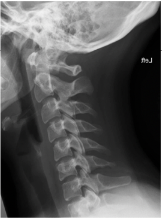 <p>A decreased lordotic curve of the cervical spine is indicative of</p>