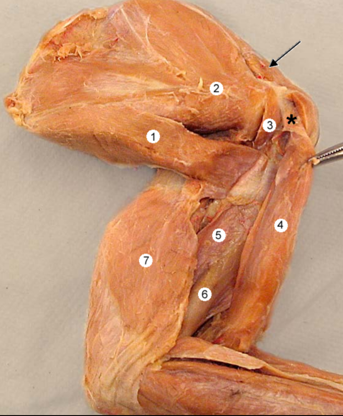 <p>Subscapularis m. #2</p>