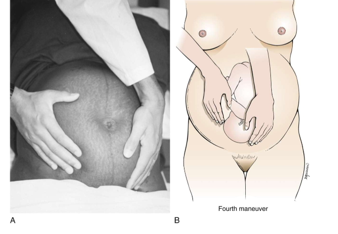 <ul><li><p>on fetal presenting part</p></li></ul><p></p>