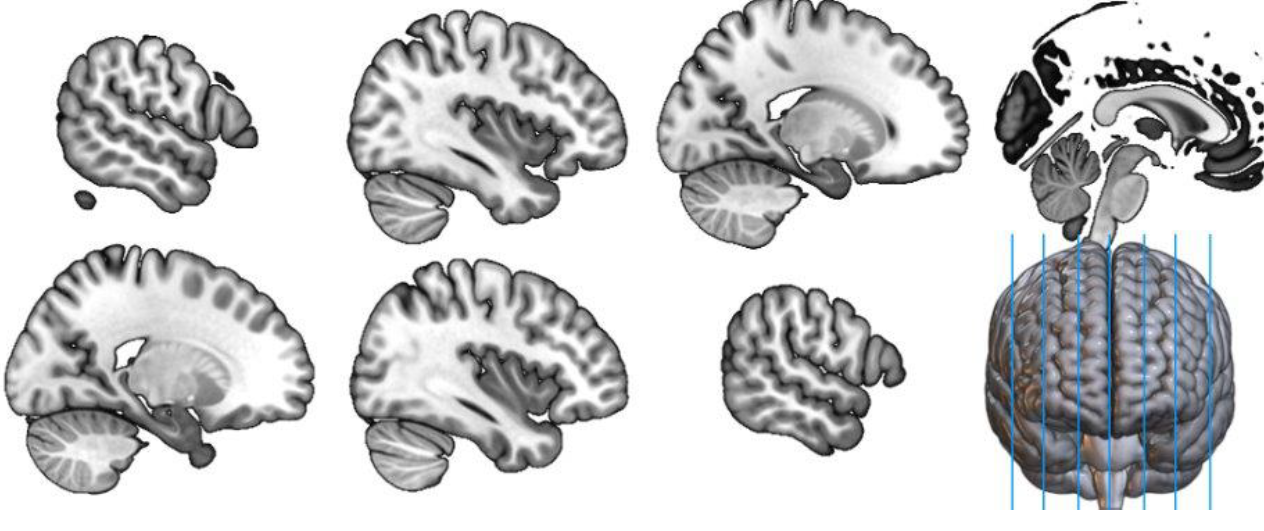 <p>split brain into left and right hemisphere, the corpus callosum connects them, also brainstem, closer to the midline</p>