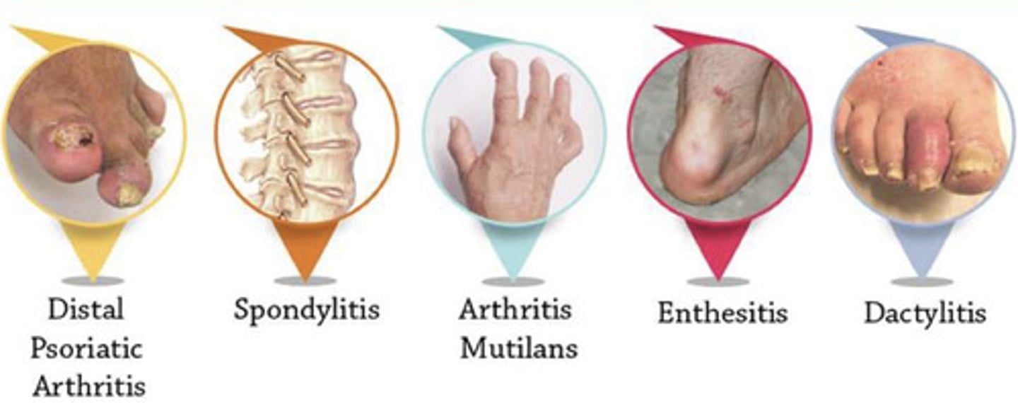 <p>(1) Distal Psoriatic Arthritis</p><p>(2) Spondylitis</p><p>(3) Arthritis Multilans</p><p>(4) Enthesis</p><p>(5) Dactylitis</p>