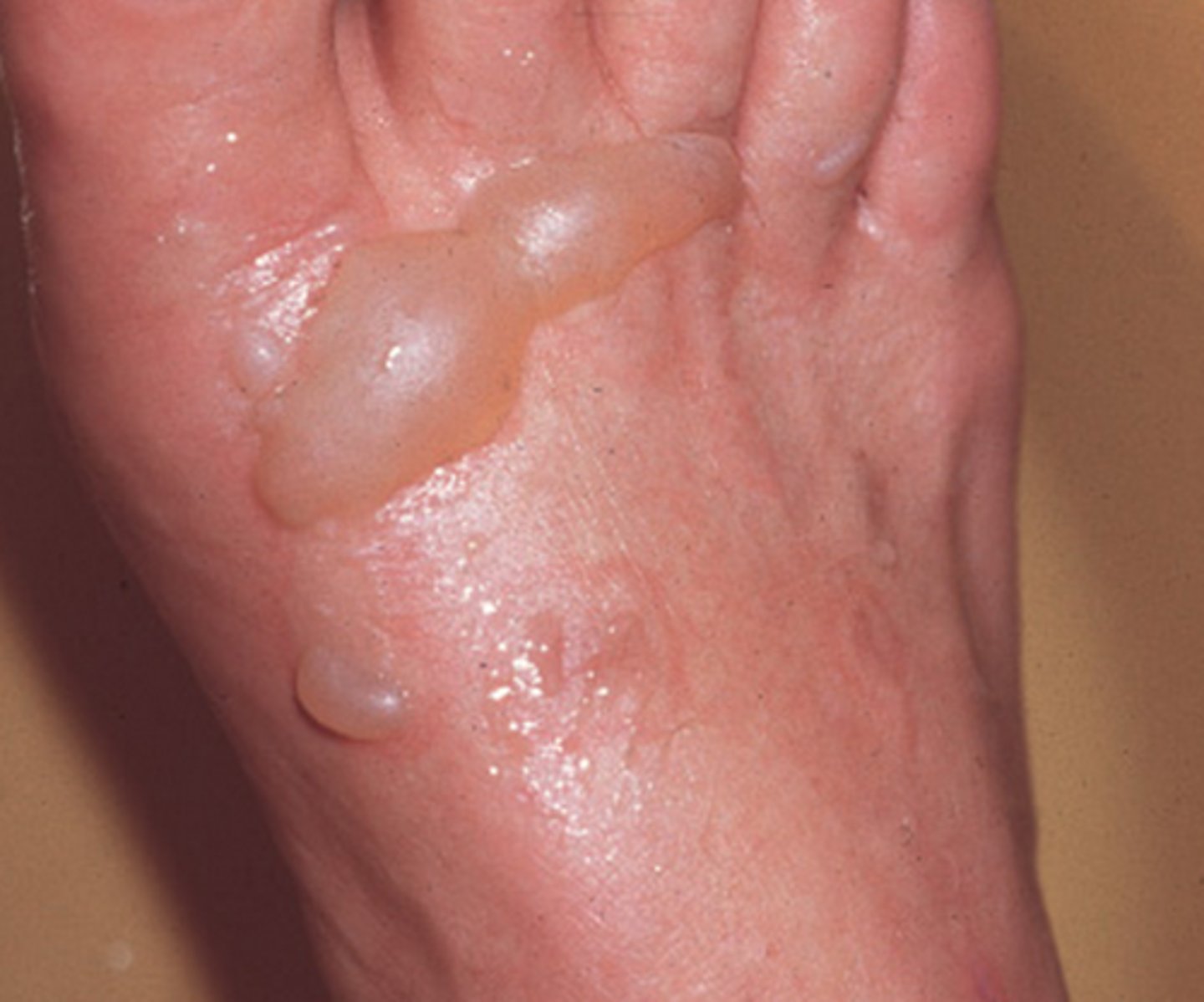 <p>epidermis and part of dermis (blistered)</p>