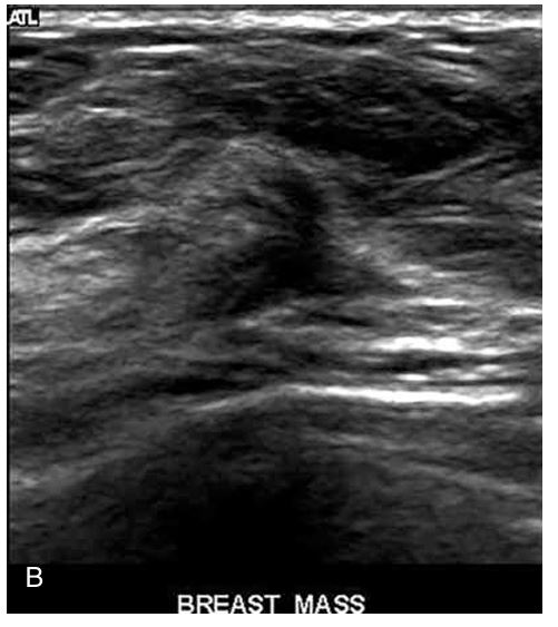 <p> ________ are associated with malignancy as are microlobulations (very small 1- to 2-mm lobulations) </p>