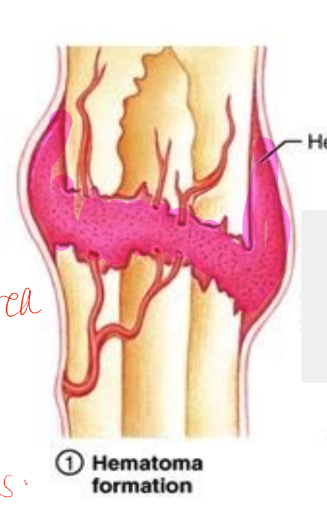 <ul><li><p> first few days to week&nbsp;</p></li><li><p>local cell death due to ischemia&nbsp;</p></li><li><p>local swelling and warmth&nbsp;</p></li><li><p>inflammatory cells invade and release lysosomal enxymes&nbsp;</p></li><li><p>osteoblastic/osteoclastic activity is stimulated&nbsp;</p></li><li><p>hematoma develops&nbsp;</p></li></ul><p></p>