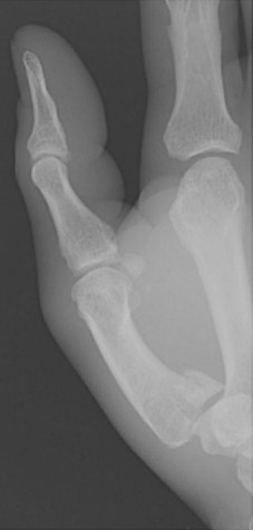 <p>Which fracture is this?</p>