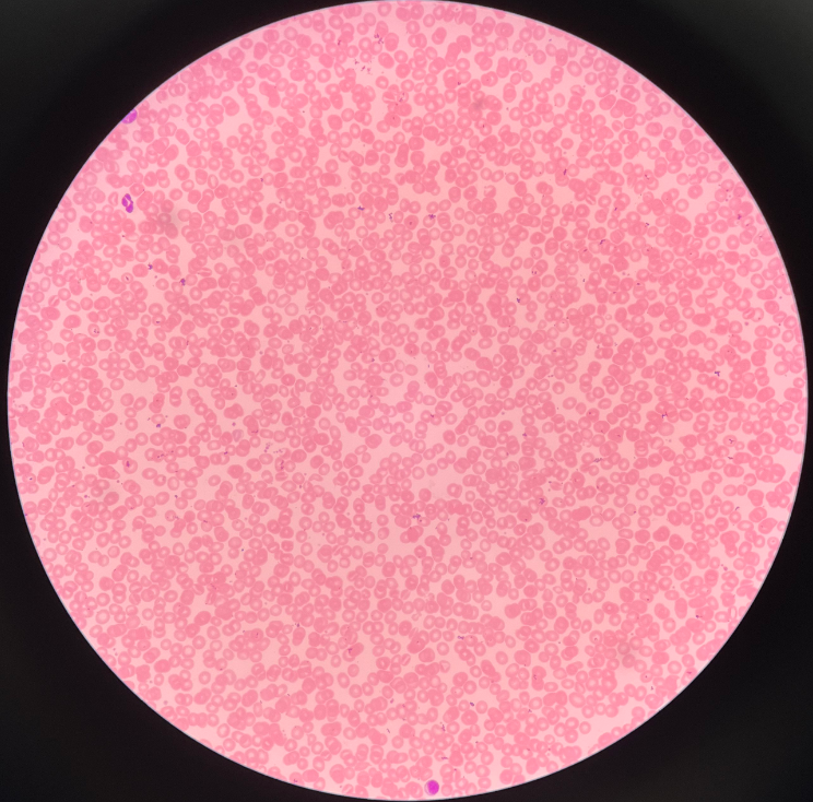 • Type of anemia.

• Insufficient iron in the body prevents the formation of hemoglobin.

• Erythrocytes appear smaller and more pale in color.