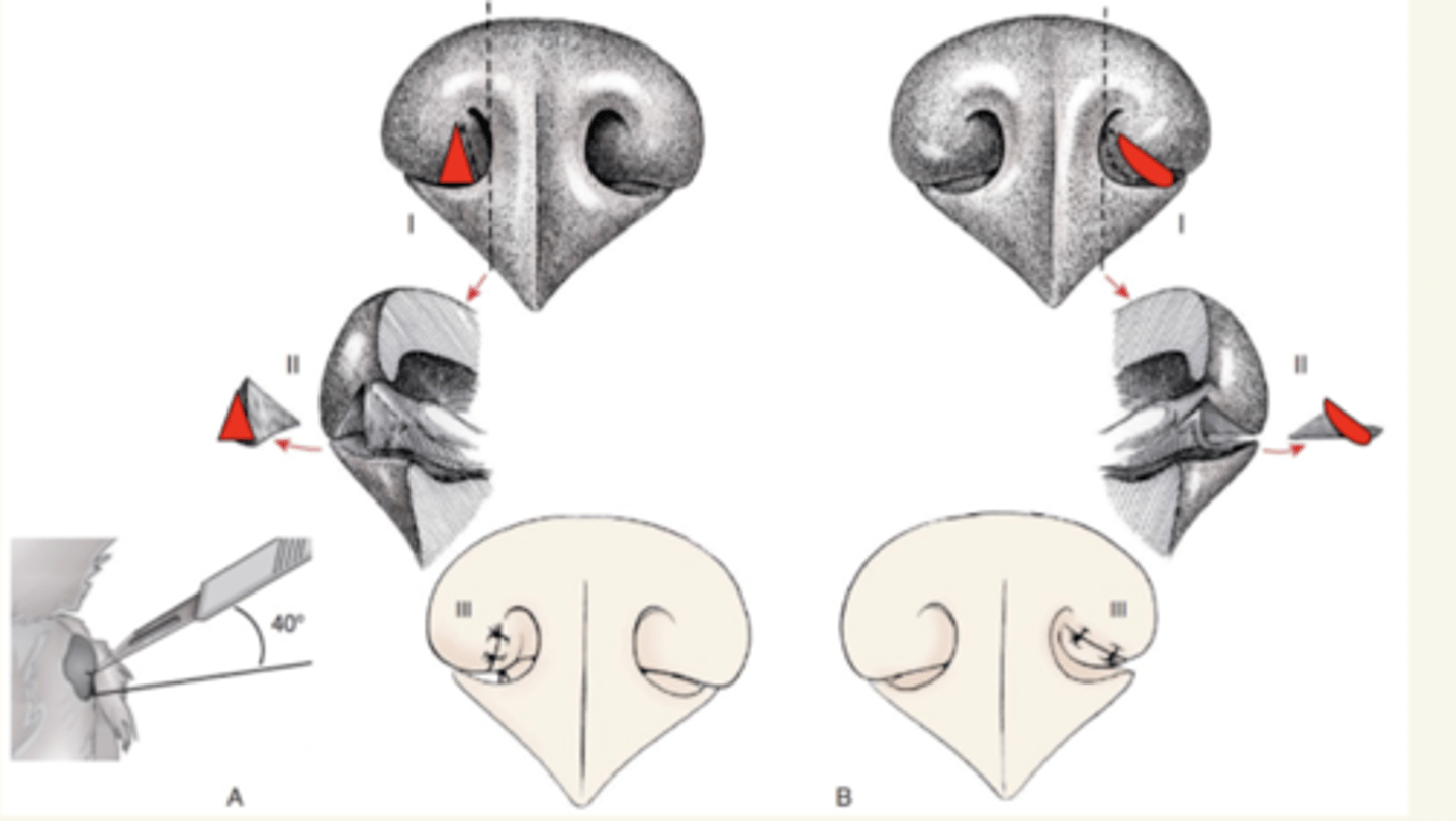 <p>quitamos la parte del cartílago nasal-dorsal en forma de cuña O triangulo</p>