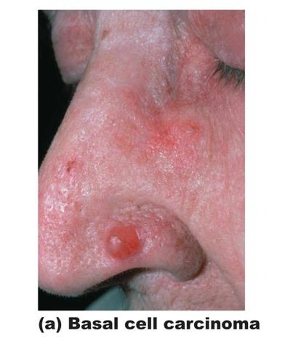 <p>malignant epithelial tumor arising from the bottom layer of the epidermis called the basal layer; it seldom metastasizes, but invades local tissue and may recur in the same location. Common in individuals who have had excessive sun exposure.</p>