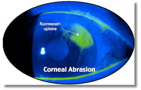 <p>fluorescein stain to r/o corneal abrasion or corneal ulcer (pooling of stain)</p>