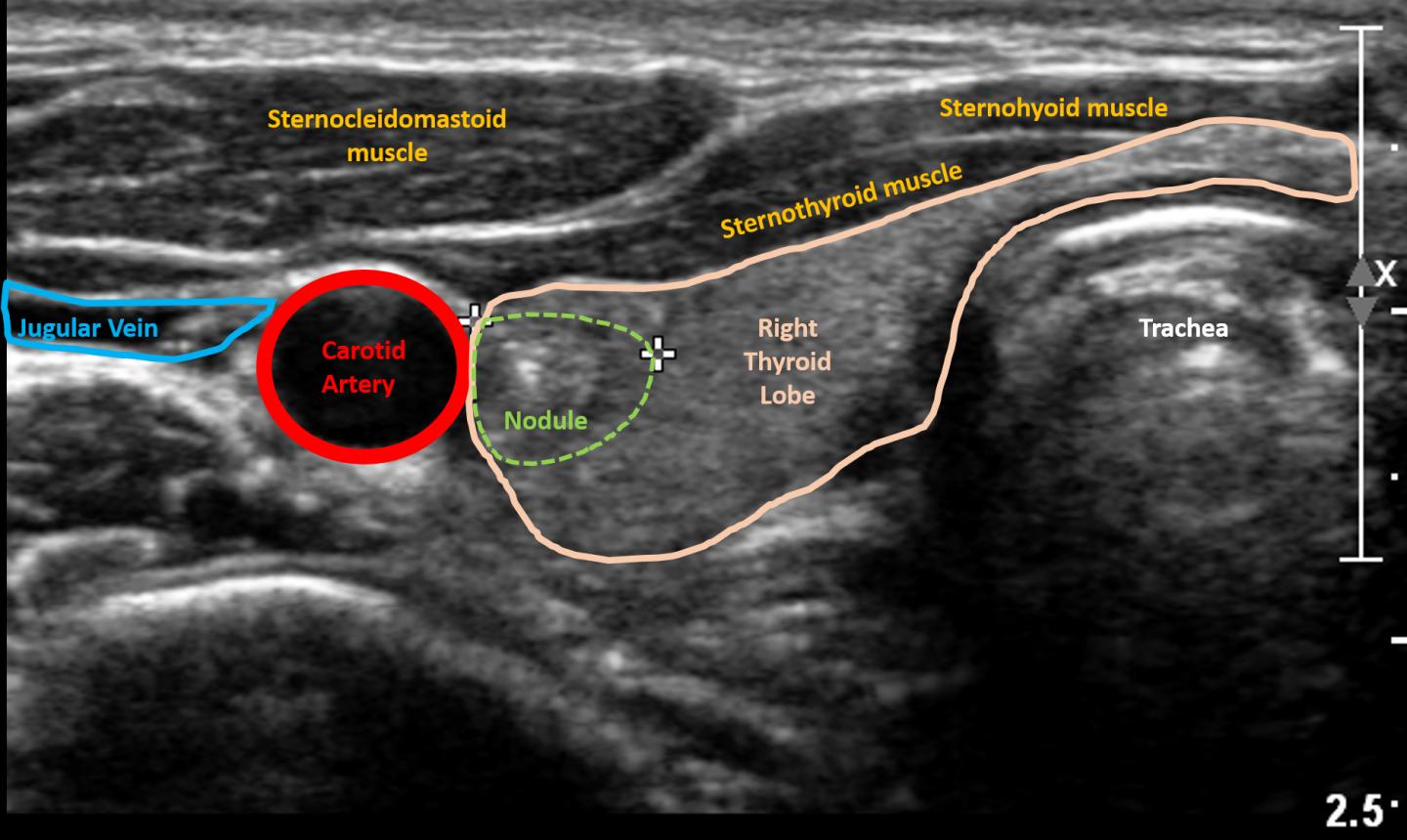 <p>strap muscles (h,t,omo)</p><p>sterno. muscle</p><p>R lobe</p><p>isthmus</p><p>trachea</p><p>CCA</p><p>IJV</p>