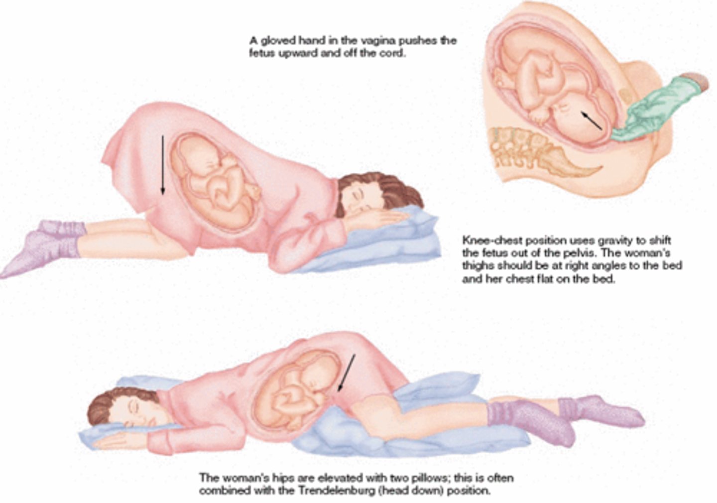 <p>Push head up and off the cord</p><p>Position mother in knee-chest</p><p>Prep for C-section</p>